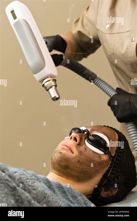Carbon Face Peeling Procedure In Beauty Salon Laser Pulses Clean Skin