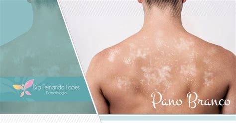 Dra Fernanda Lopes Dermatologia Blog Pano Branco