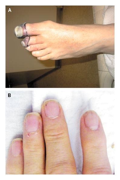 Painful Purple Toes Nejm