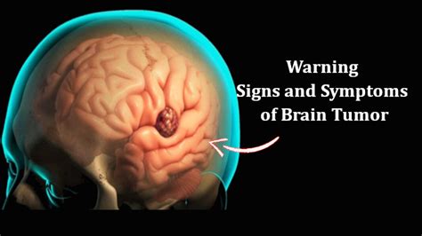 Early Signs And Symptoms Of Brain Tumor In Women And Men