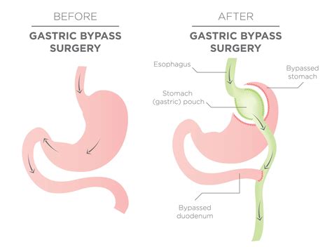 Weight Loss Surgery Costs In The Uk And Abroad Qunomedical