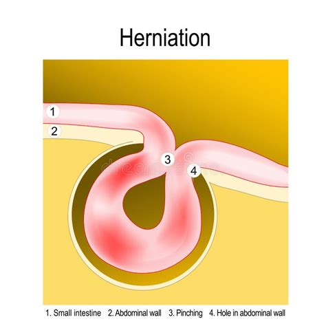 Strangulated Hernia Stock Illustrations 42 Strangulated Hernia Stock