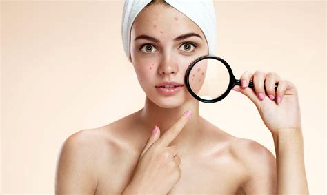Acne In Women Causes And Treatments Miami Center Of Excellence Dr