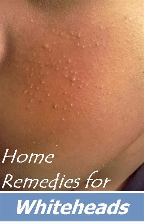 Home Remedies For Whiteheads Natural Beauty Secrets Natural Skin