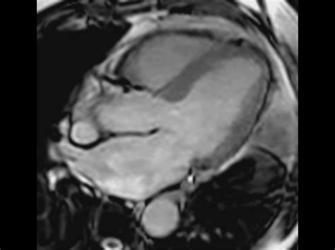 Cardiac Mri Arrhythmia Patient Philips Mr Body Map