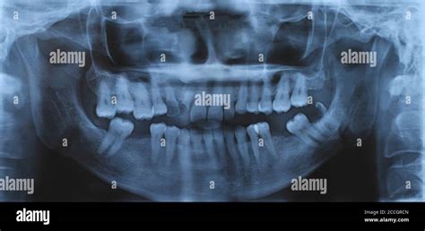 Panoramic Dental And Mandible X Ray Image Stock Photo Alamy