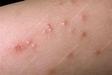 Molluscum Contagiosum Stock Image C051 5765 Science Photo Library