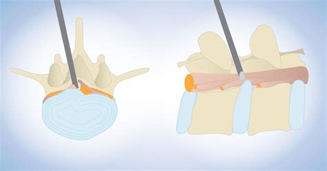 Intralaminar Lumbar Micro Endoscopic Discectomy Atlanta Ga Spine Surgery