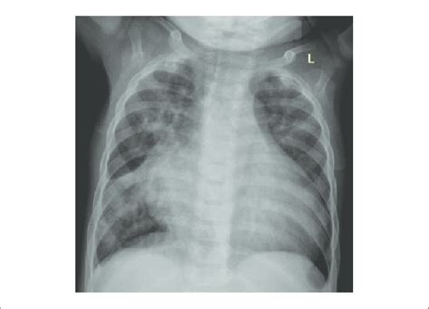 Chest X Ray Ap View Displaying Cardiomegaly Increased Vascular
