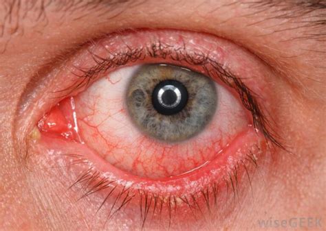 Does High Blood Pressure Cause Red Eyes 27f Chilean Way