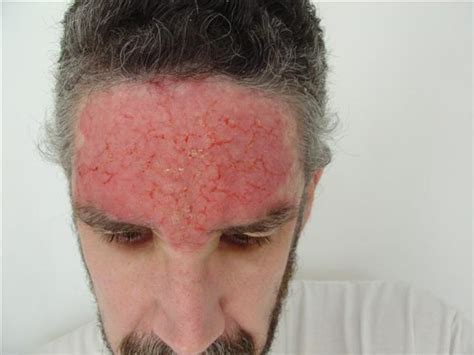 Skin Cancer Skin Cancer On Forehead