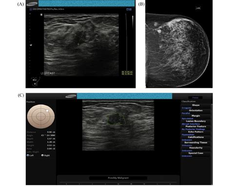 A 45 Year Old Woman With A Palpable Lump In The Left Breast Ultrasound