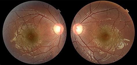 Fundus Photographs Of The Patient Excyclotorsion And Decreased Foveal