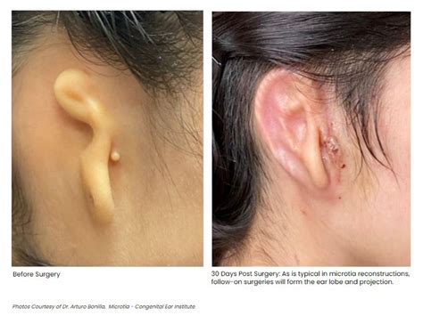 Woman Receives 3d Printed Ear Transplant In ‘groundbreaking