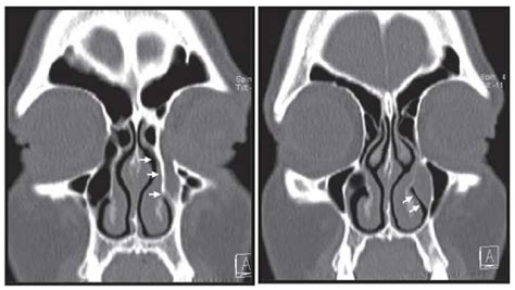 Nasolacrimal Cyst