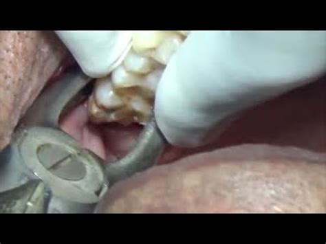 Decayed Upper Wisdom Tooth Extraction Youtube