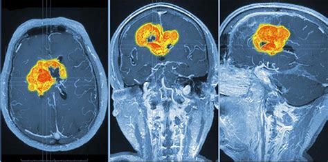 Brain Tumour Mri Scan Photograph By Pasieka Fine Art America