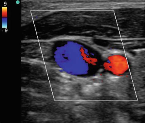 Ultrasound Guided Central Venous Access Springerlink