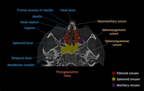 Cranial Bone Anatomy Ct Axial