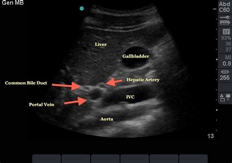 Emory Emergency Ultrasound Follow The Mlf To Find The Portal Triad