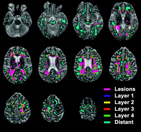 Normal Appearing White Matter Changes Vary With Distance To Lesions In