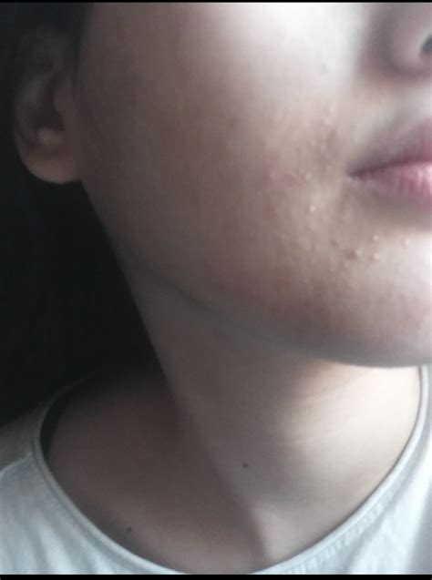 Perioral Dermatitis Or Acne Pictures General Acne Discussion