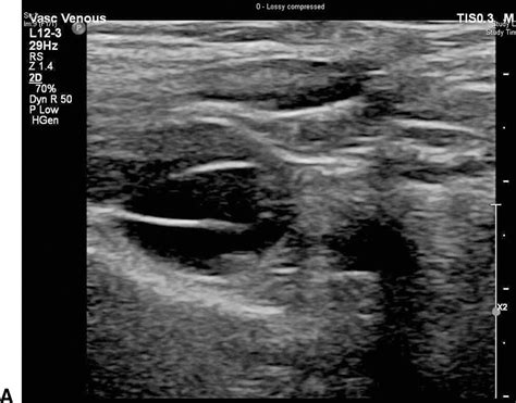 Venous Anatomy And Hemodynamics Thoracic Key