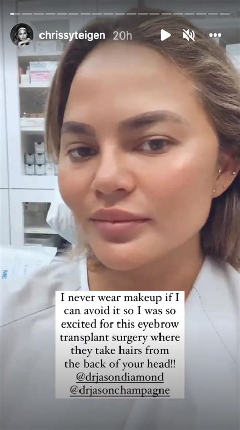 Chrissy Teigen Undergoes Eyebrow Transplant Surgery