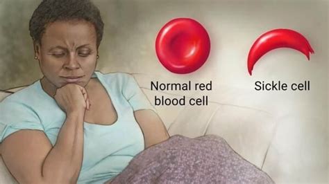 Sickle Cell Disease Doctors Reveal Causes Symptoms Preventive Tips
