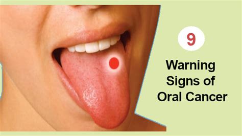 9 Warning Signs Of Oral Cancer And Steps For Prevention