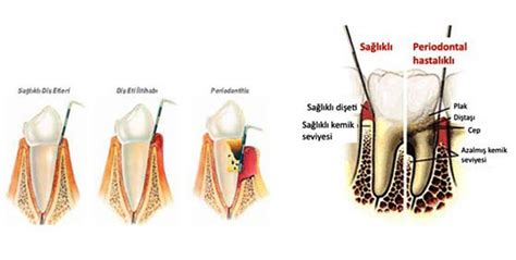 İzmir Diş Eti Hastalıkları Periodontoloji Tedavisi DentAgora