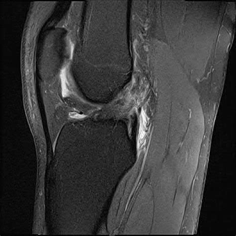Cureus Seeing Double A Case Of Acl Tears In Monozygotic Twin Female