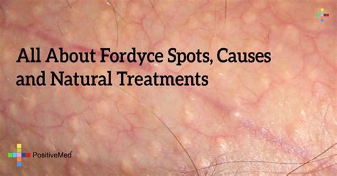All About Fordyce Spots Causes And Natural Treatments