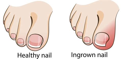 Cutting your toenails too short or not straight across 3. How to Get Rid of an Ingrown Toenail - Healthy Focus