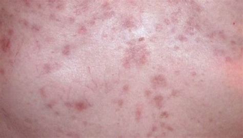 Papular Eczema Symptoms Causes And Treatment