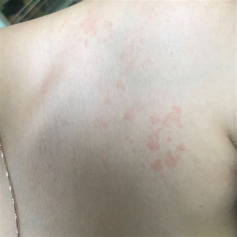 What Is This Ive Had This Weird Rash For Months And It Randomly Pops