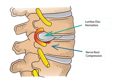 Herniated Disc Symptoms Typically A Low Back Ache