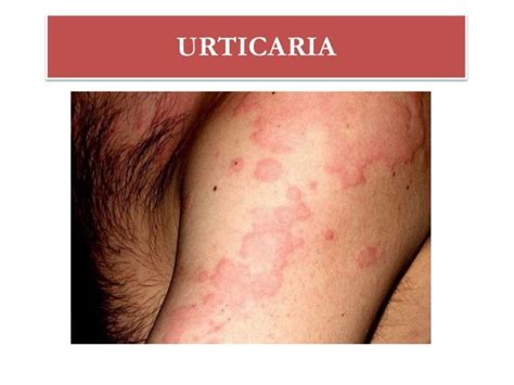 Urticaria Urgencias2 Ppt 2003