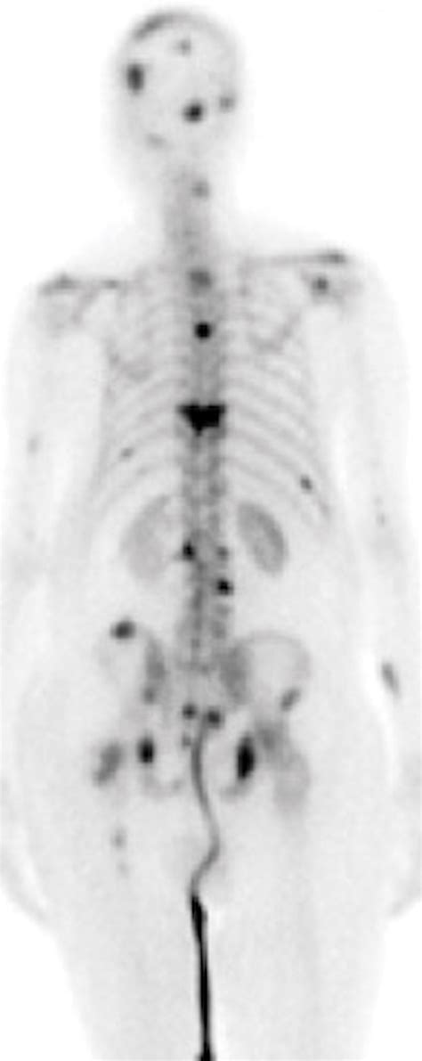 Clinical Pet Imaging In Prostate Cancer Radiographics