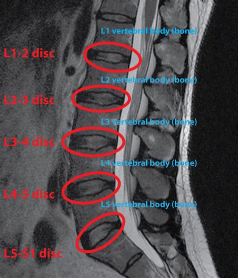 How To Understand Your Complex Spine Mri In 8 Easy Steps Healthcare
