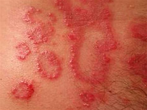 Sebopsoriasis Causes Symptoms Dr Thind Homeopathy