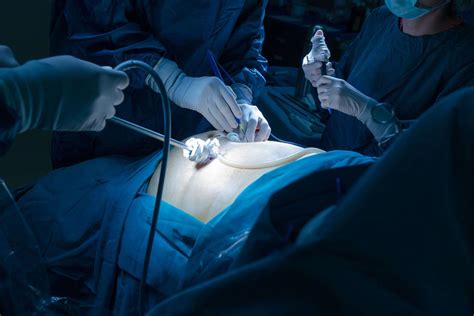 Hiatal Hernia Surgery What To Expect On The Day Of Surgery 2022