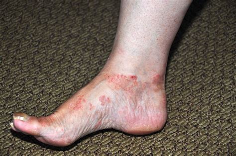 Heat Rash On Top Of Feet Foot Rash Causes Symptoms Home Remedies And Treatment Avoid
