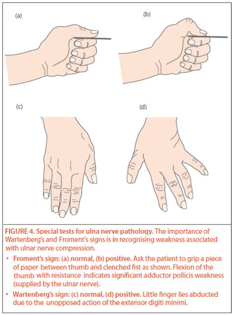 Froments Sign Flexion Of Thumb Ip With Lateral Pinch Sign Of Ulnar