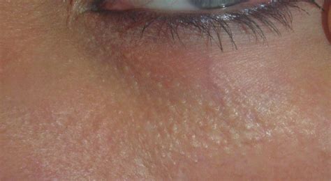 What Are The Skin Colored Bumps Under My Eyes 5 Thing