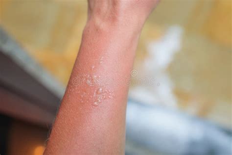 Burn Blister On The Arm Skin Due To Hot Oil Stock Image Colourbox