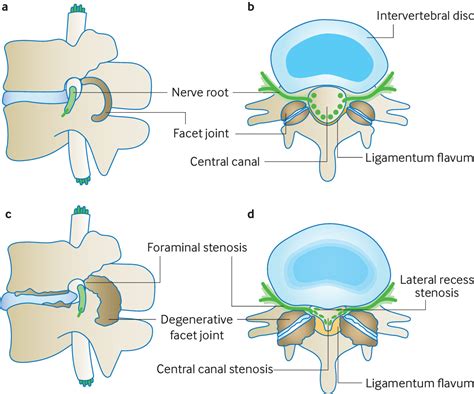 Lumbar Spinal Stenosis The Bmj