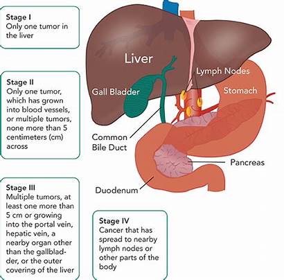Liver Cancer Stage Stages Staging Tumors Facts