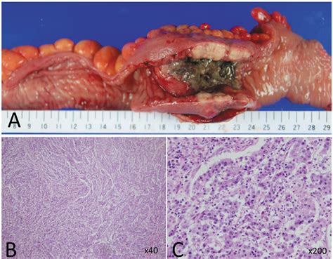 Virchow Lymph Node Metastatic Recurrence Of Sigmoid Colon Cancer With