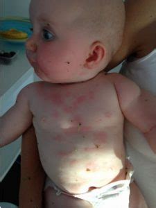 Hives could show up anywhere on your baby's body. allergic food reaction to kiwi fruit